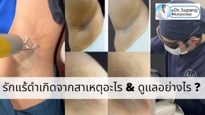 รักแร้ดำเกิดจากสาเหตุอะไร & ดูแลอย่างไร ?