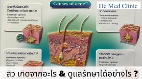 สิว เกิดจากอะไร & ดูแลรักษาได้อย่างไร ?