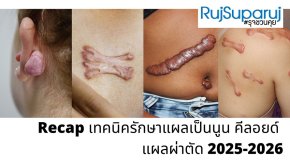 Recap | เทคนิคการรักษาแผลเป็นนูนคีลอยด์ 20252026