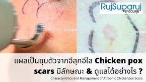 "แผลเป็นหลุมอีสุกอีใส" (Chicken Pox Scars) ลักษณะเฉพาะและการรักษา ?
