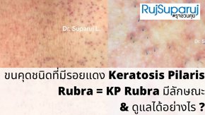 ขนคุดชนิดที่มีรอยแดง Keratosis Pilaris Rubra = KP Rubra มีลักษณะอย่างไร & ดูแลได้อย่างไร ?