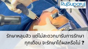 รักษาหลุมสิว แต่ไม่สะดวกมารับการรักษาทุกเดือน จะรักษาได้ผลหรือไม่ ?