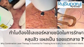 ทำไมต้องใช้เลเซอร์หลายชนิดในการรักษาหลุมสิว แผลเป็น รอยแตกลาย ?