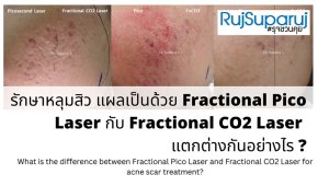 เจาะลึกความแตกต่าง: Fractional CO2 vs Fractional Picosecond Laser ในการรักษาหลุมสิว