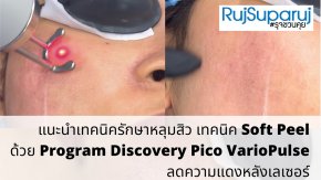 แนะนำเทคนิครักษาหลุมสิว เทคนิค Soft Peel ด้วย Program Discovery Pico VarioPulse ลดความแดงหลังเลเซอร์