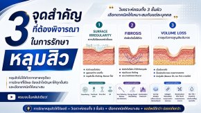 3 จุดสำคัญที่ต้องพิจารณาในการรักษาหลุมสิว: Surface Irregularity, Fibrosis และ Volume Loss