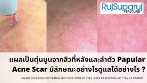 แผลเป็นตุ่นนูนจากสิวที่หลังและลำตัว Papular Acne Scar มีลักษณะอย่างไรดูแลได้อย่างไร ?