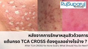 การดูแลผิวและแนวทางการป้องกันรอยดำหลังการรักษาหลุมสิวด้วย TCA CROSS