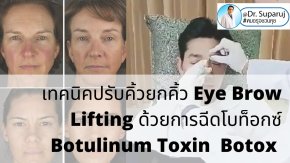 เทคนิคปรับคิ้วยกคิ้ว Program Eye Brow Lifting ด้วยการฉีดโบท็อกซ์ Botulinum Toxin Botox