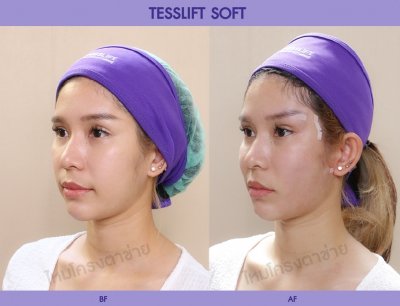 Tesslift Soft