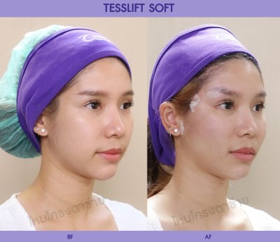 Tesslift Soft