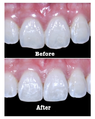 best dental clinic in bangkok before after teeth restoration