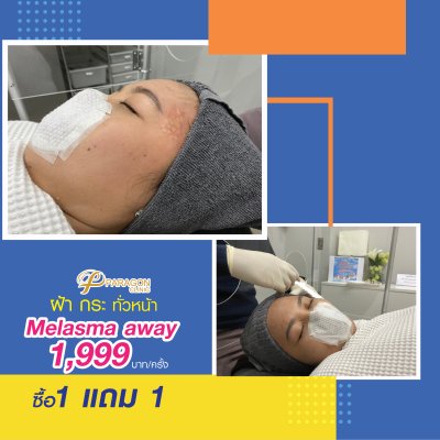 Melasma away