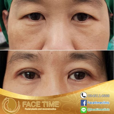 การผ่าตัดชั้นตา / รอบดวงตา (Blepharoplasty)