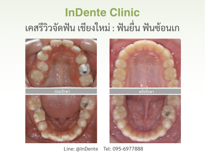 เคสรีวิว