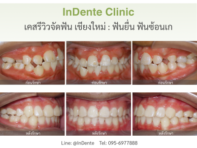 เคสรีวิว