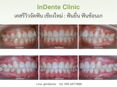 เคสรีวิว
