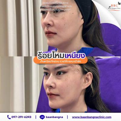 ร้อยไหมเหนียง