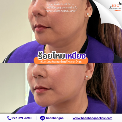 ร้อยไหมเหนียง
