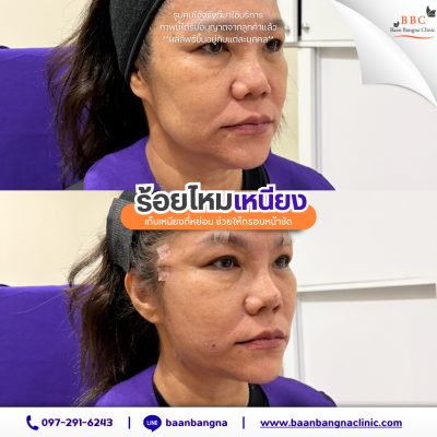 ร้อยไหมเหนียง