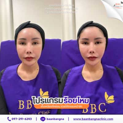 รีวิวร้อยไหมยกกระชับ