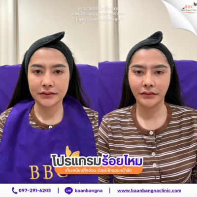 รีวิวร้อยไหมยกกระชับ