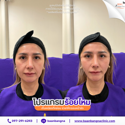 รีวิวร้อยไหมยกกระชับ