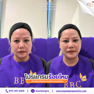 รีวิวร้อยไหมยกกระชับ