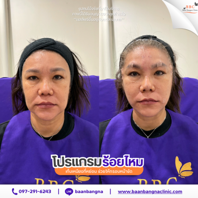 รีวิวร้อยไหมยกกระชับ