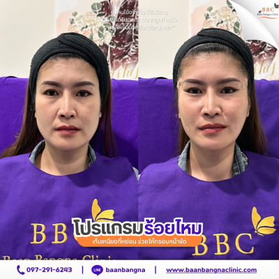รีวิวร้อยไหมยกกระชับ