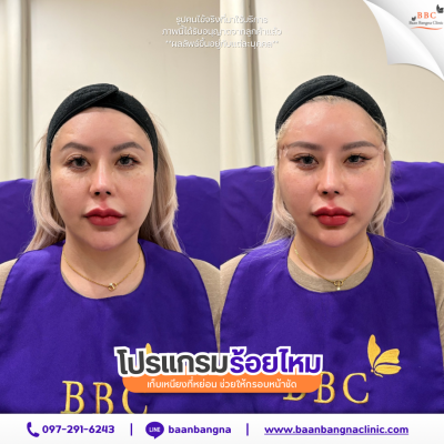 รีวิวร้อยไหมยกกระชับ