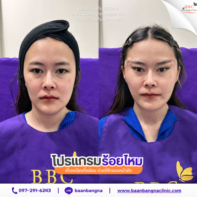 รีวิวร้อยไหมยกกระชับ