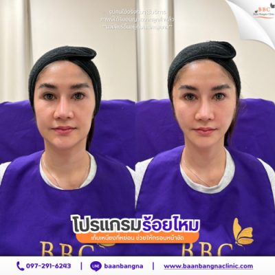 รีวิวร้อยไหมยกกระชับ