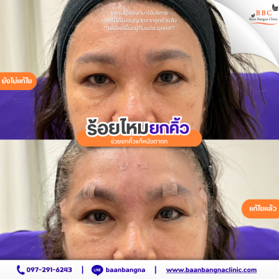 ร้อยไหมตาคิ้วจมูก