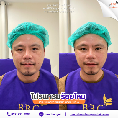 ร้อยไหมผู้ชาย
