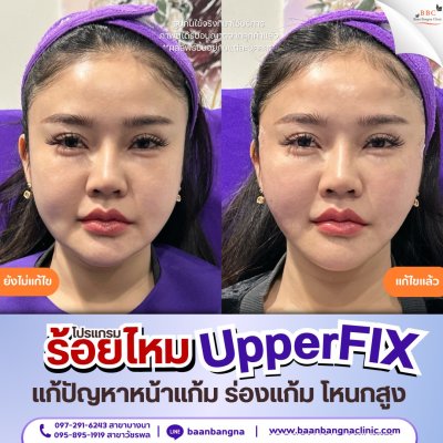 upperfix