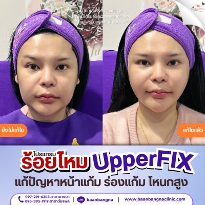 upperfix