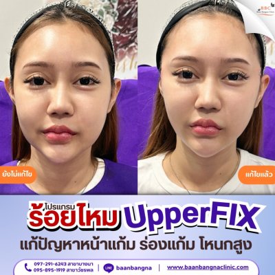 upperfix