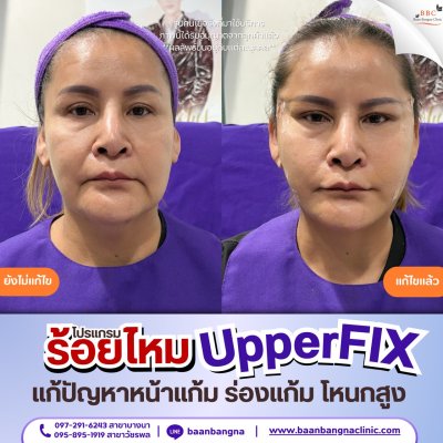 upperfix