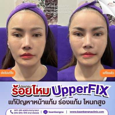 upperfix
