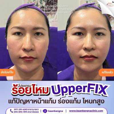 upperfix