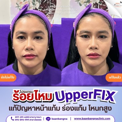 upperfix