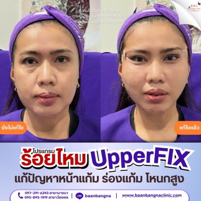 upperfix