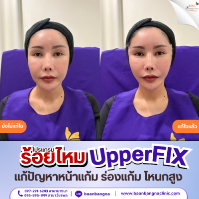 upperfix