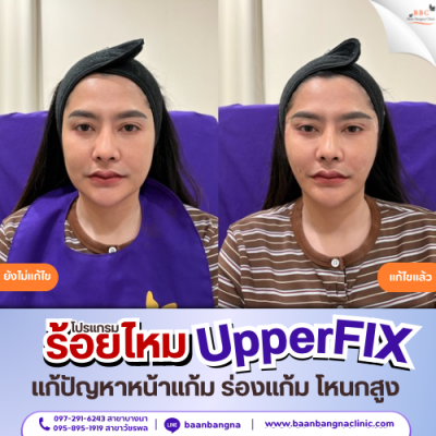 upperfix