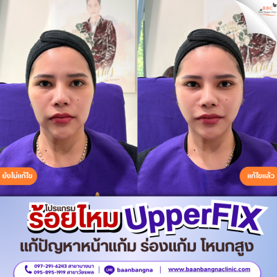 upperfix