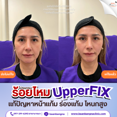 upperfix