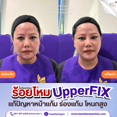 upperfix