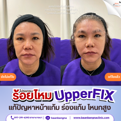 upperfix