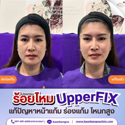 upperfix